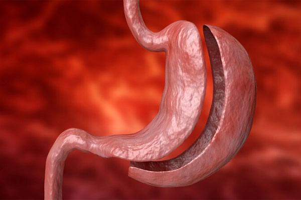 اسلیو گاسترکتومی (Sleeve Gastrectomy)