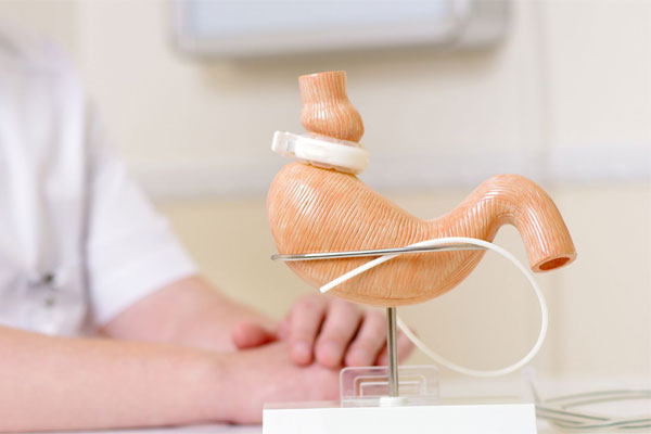 حلقه قابل تنظیم معده (Adjustable Gastric Banding — AGB)